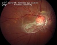 von-Hippel Disease